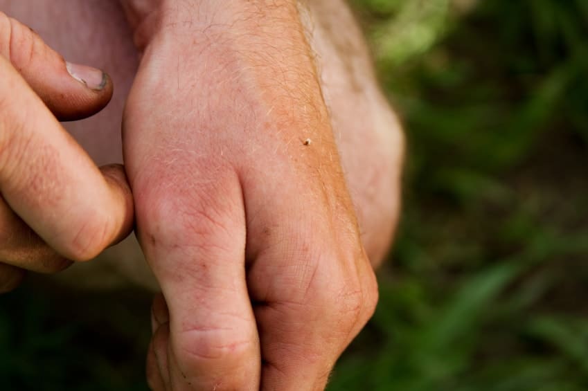 insect related injuries